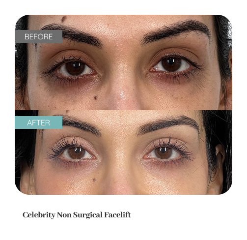 Before and after treatment result — Dr. Lanna, LC Medical Aesthetics NYC